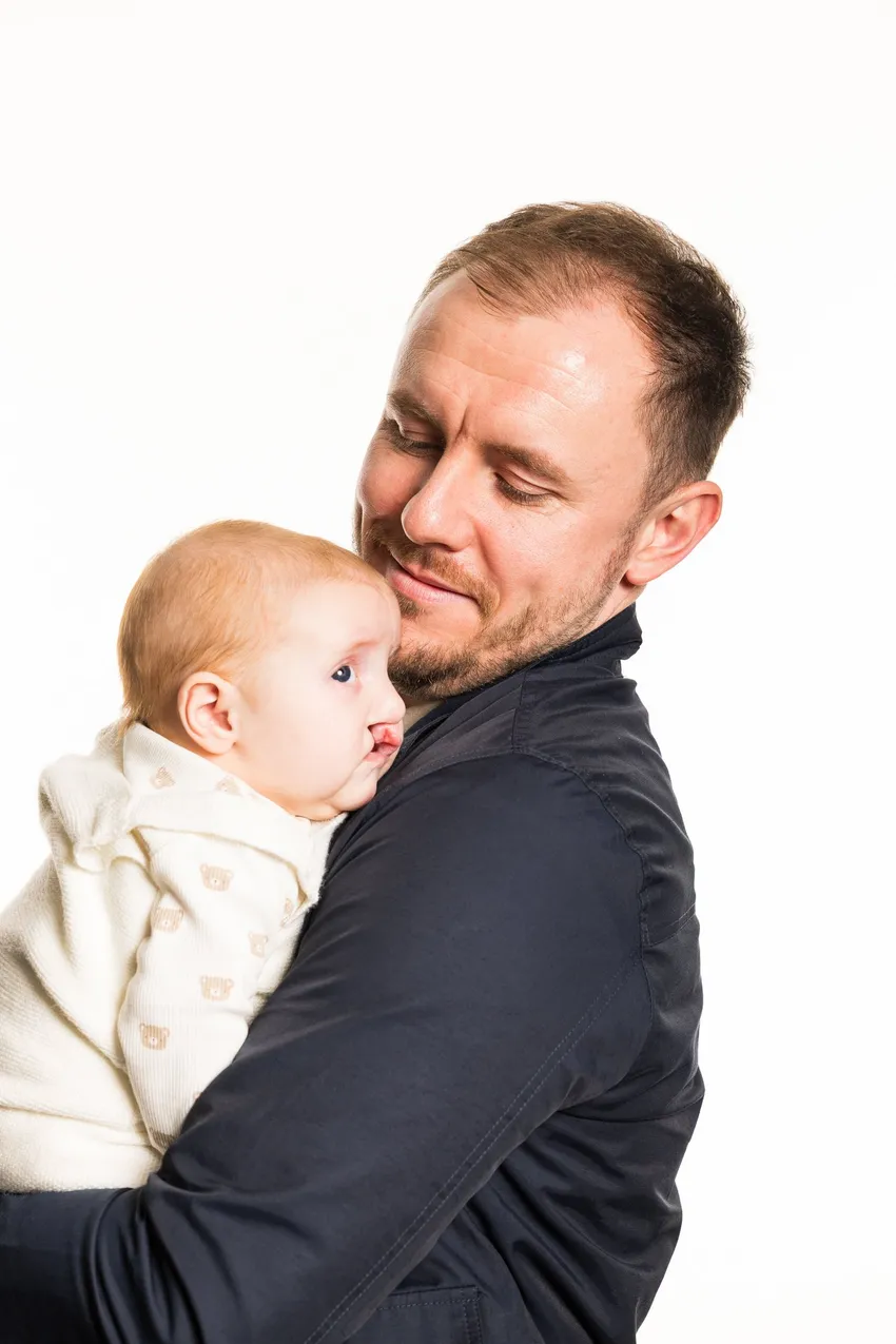 Baby Ritchie was born with a cleft lip and palate